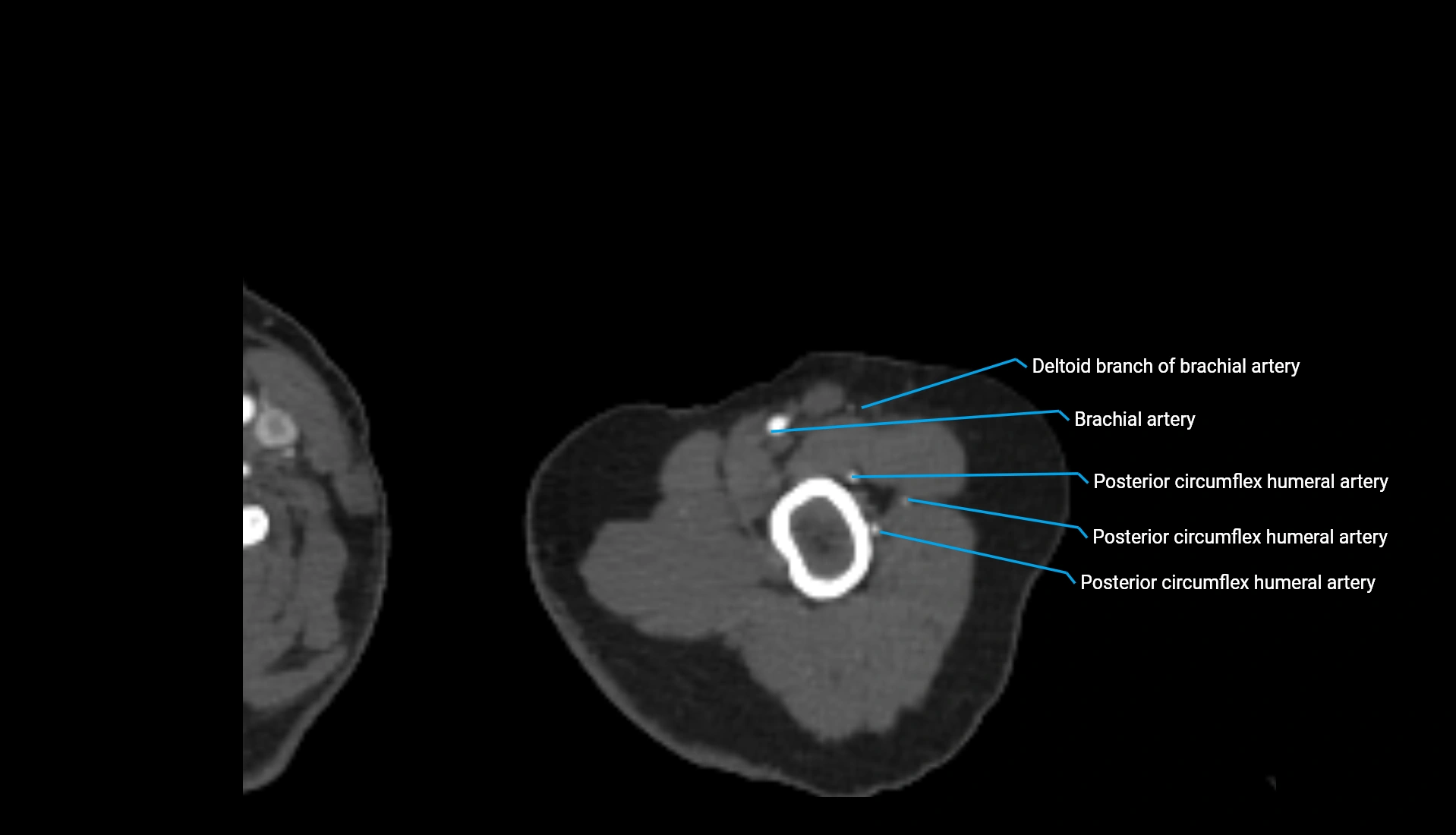 CTA upper limb axial cross sectional anatomy labelled image 308 (1).webp